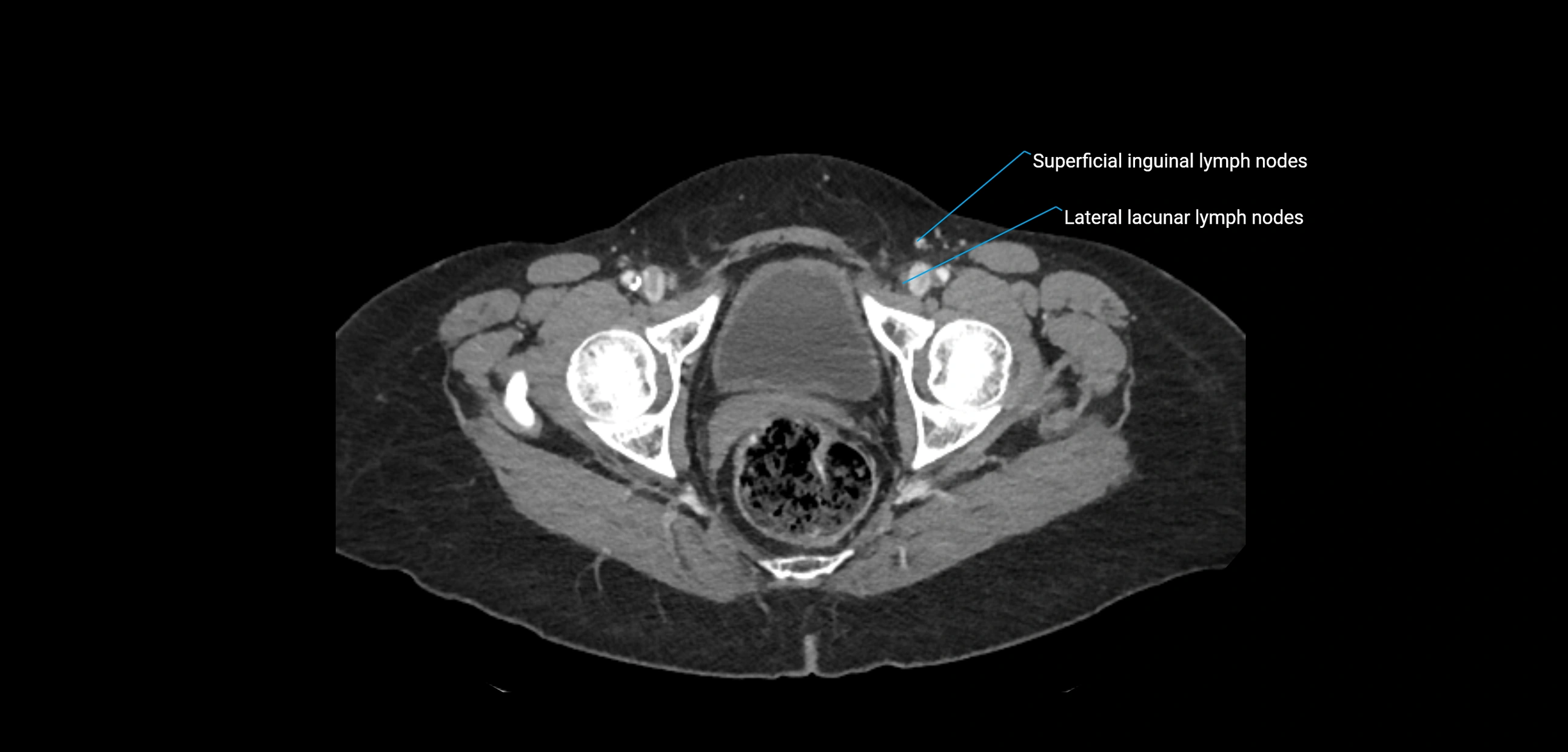 CT ct abdominal lymph nodes  axial cross sectional anatomy  enchanced radiology image -img-00002-00396.webp
